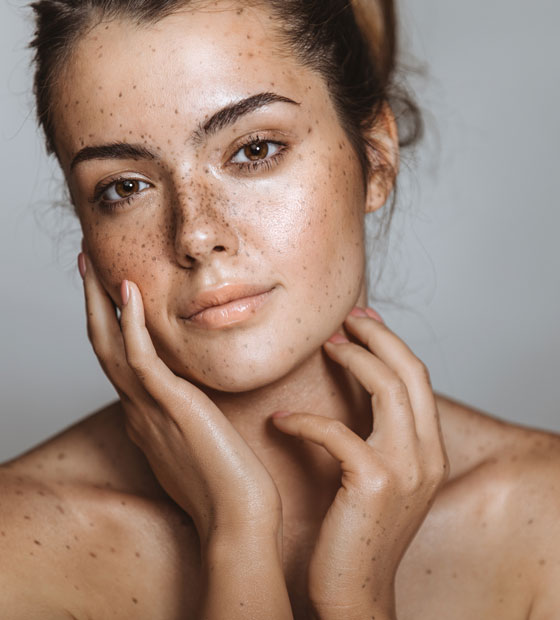 Woman After Chemical Peel Woman After Chemical Peel