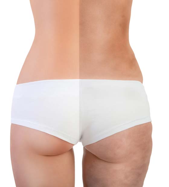 Before After body Cellulite treatment