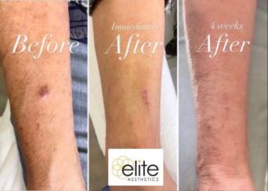 Skin Lesion Before & After