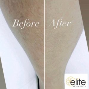 Diolaze Hair Removal