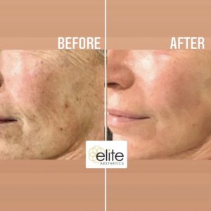 LPL Photorejuvenation