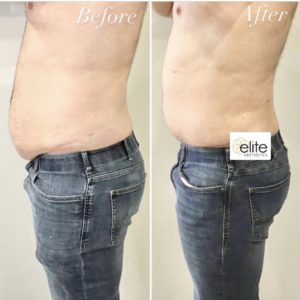 Liposuction