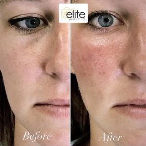 Microneedling PRP Under Eyes