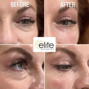 Microneedling PRP Under Eyes