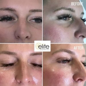 Microneedling PRP Under Eyes