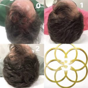 PRP Hair Restoration