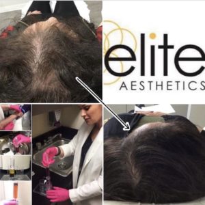 PRP Hair Restoration