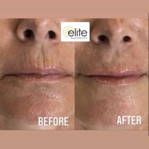 Revanesse Versa Filler