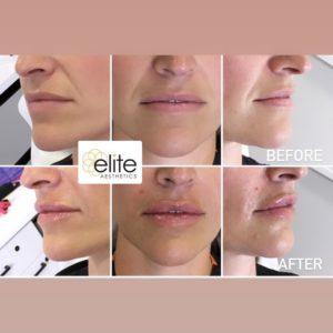 Revanesse Versa Filler