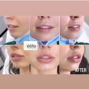 Revanesse Versa Filler