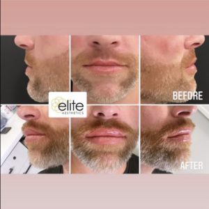 Revanesse Versa Filler