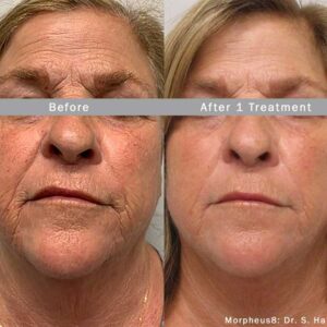 Morpheus 8 Face Skin Tightening